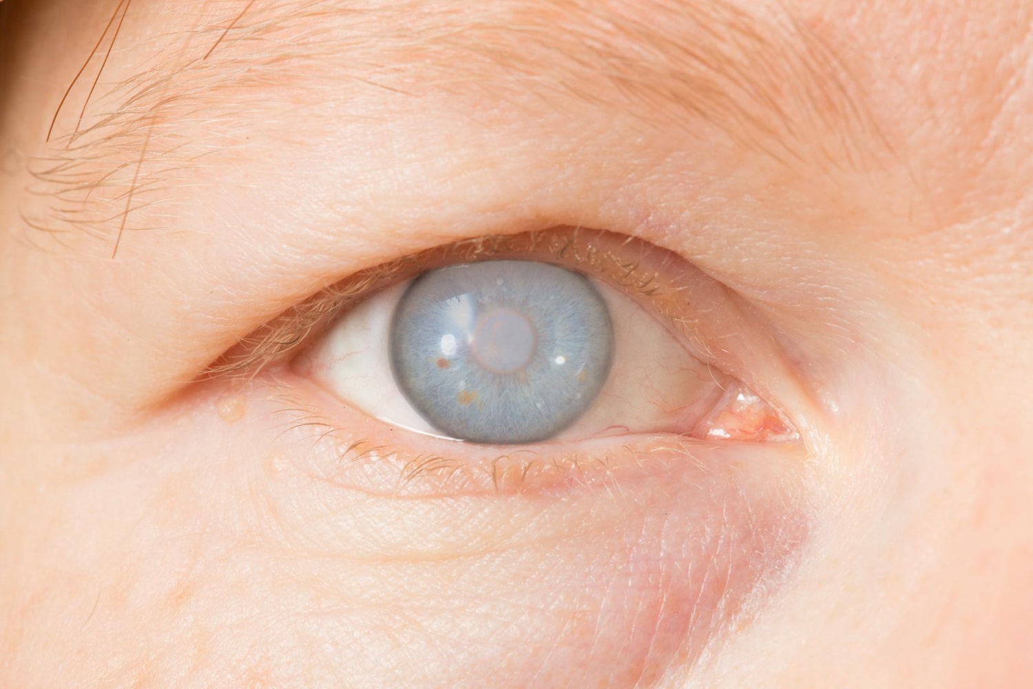 Куриная слепота (гемералопия) — что это, симптомы, лечение и почему она так называется